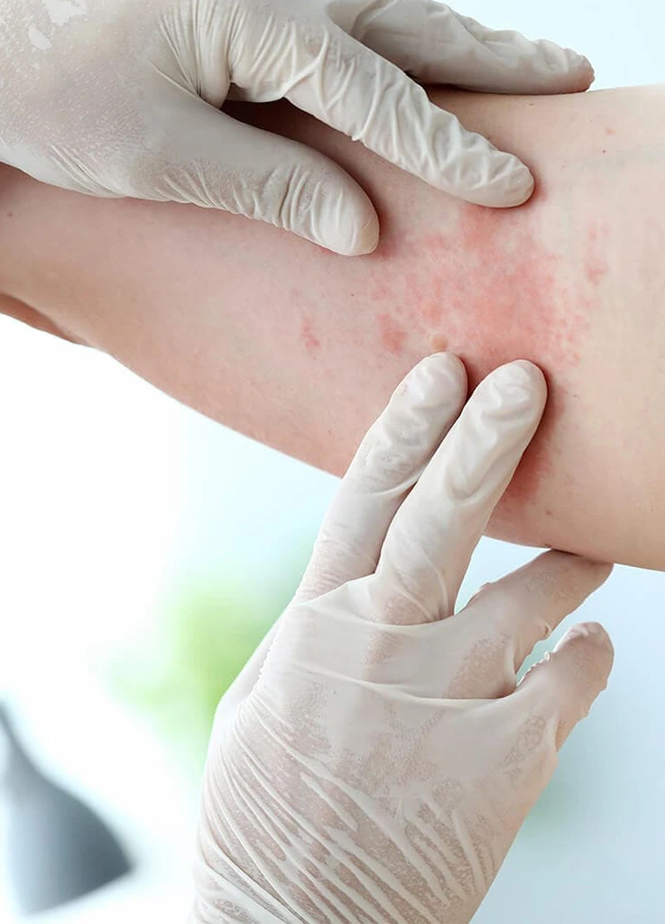 ekzema-derma-eleftheriadis-2
